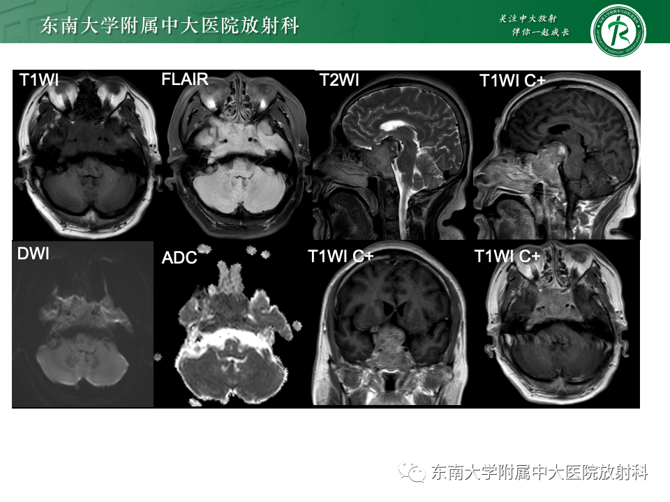 影像PPT - 【PPT】斜坡骨质破坏性病变影像诊断-9