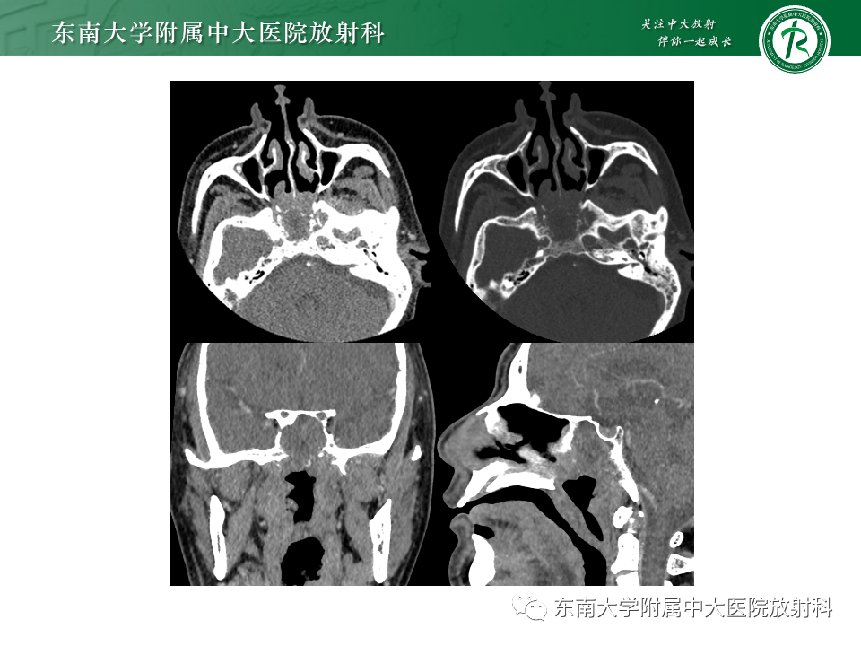影像PPT - 【PPT】斜坡骨质破坏性病变影像诊断-11