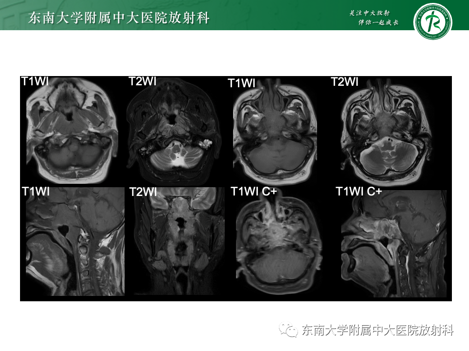 影像PPT - 【PPT】斜坡骨质破坏性病变影像诊断-12