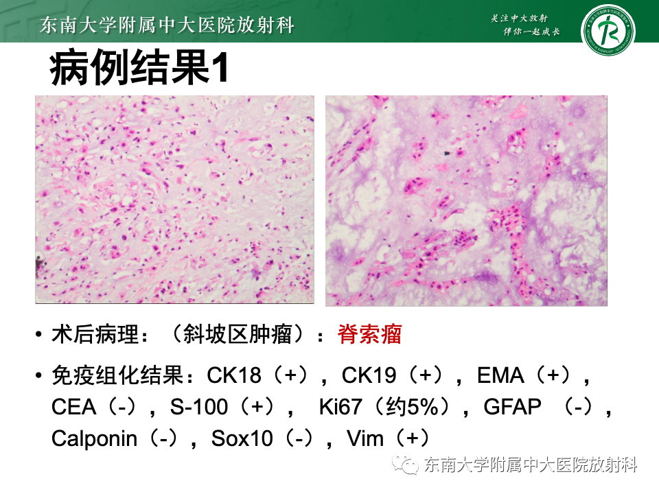 影像PPT - 【PPT】斜坡骨质破坏性病变影像诊断-13