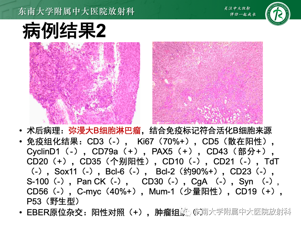 影像PPT - 【PPT】斜坡骨质破坏性病变影像诊断-14