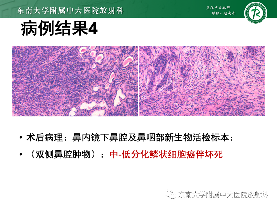 影像PPT - 【PPT】斜坡骨质破坏性病变影像诊断-17