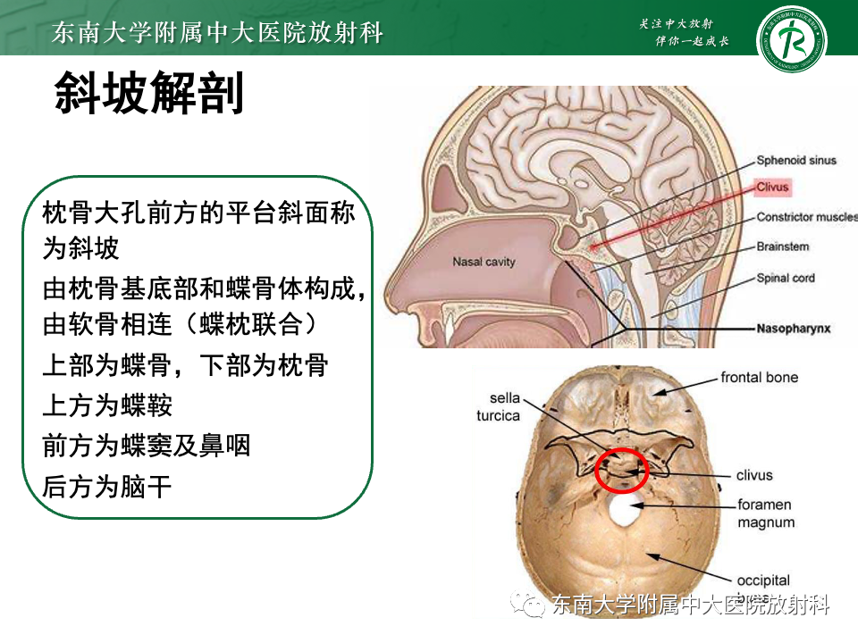 影像PPT - 【PPT】斜坡骨质破坏性病变影像诊断-22