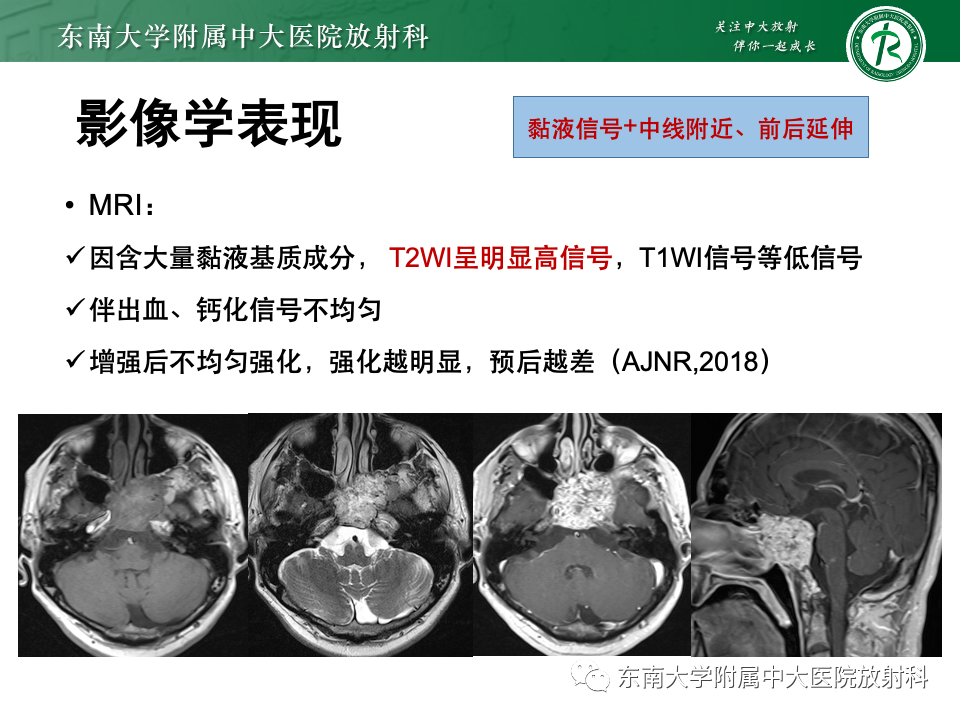 影像PPT - 【PPT】斜坡骨质破坏性病变影像诊断-27