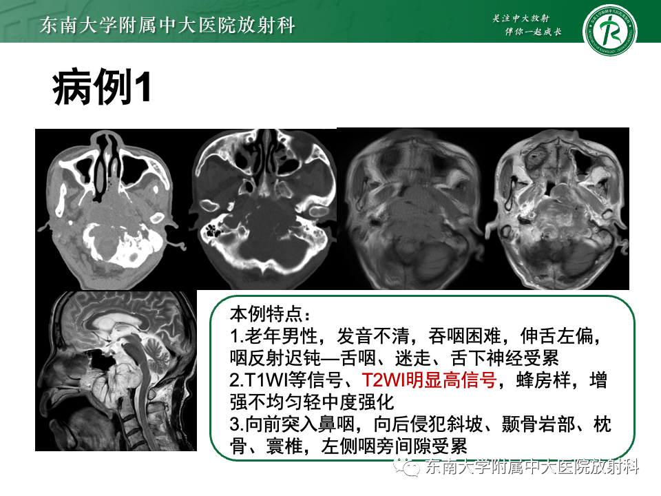 影像PPT - 【PPT】斜坡骨质破坏性病变影像诊断-28