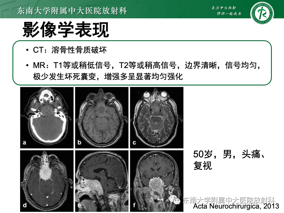 影像PPT - 【PPT】斜坡骨质破坏性病变影像诊断-30