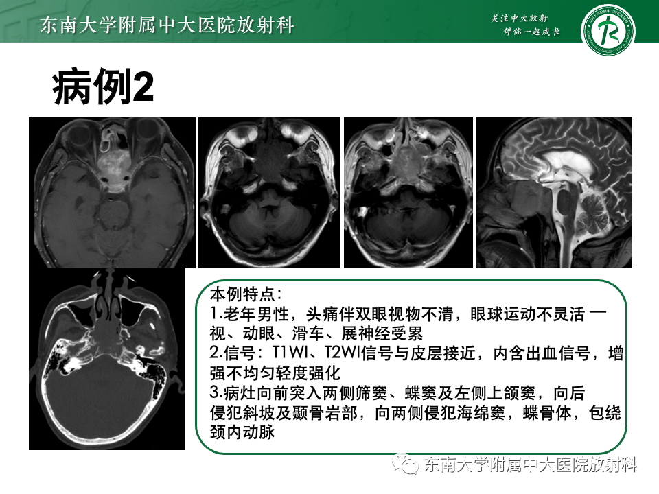 影像PPT - 【PPT】斜坡骨质破坏性病变影像诊断-34