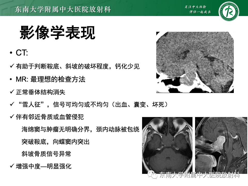 影像PPT - 【PPT】斜坡骨质破坏性病变影像诊断-38