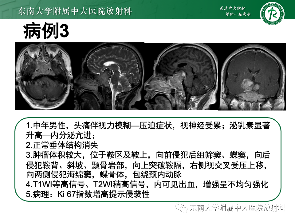影像PPT - 【PPT】斜坡骨质破坏性病变影像诊断-39
