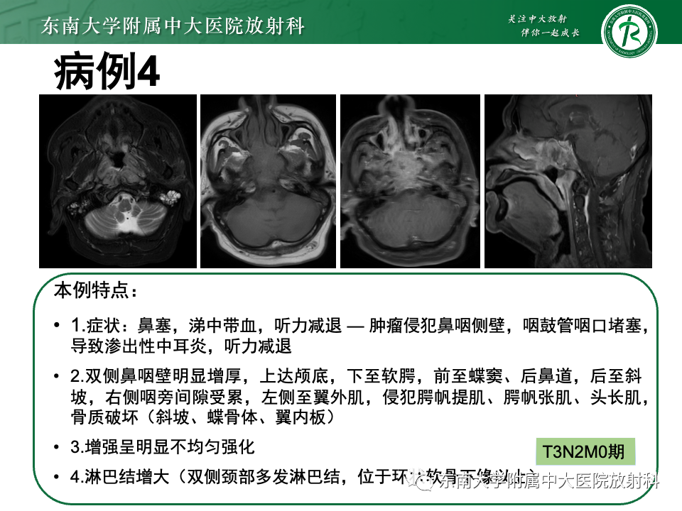 影像PPT - 【PPT】斜坡骨质破坏性病变影像诊断-45