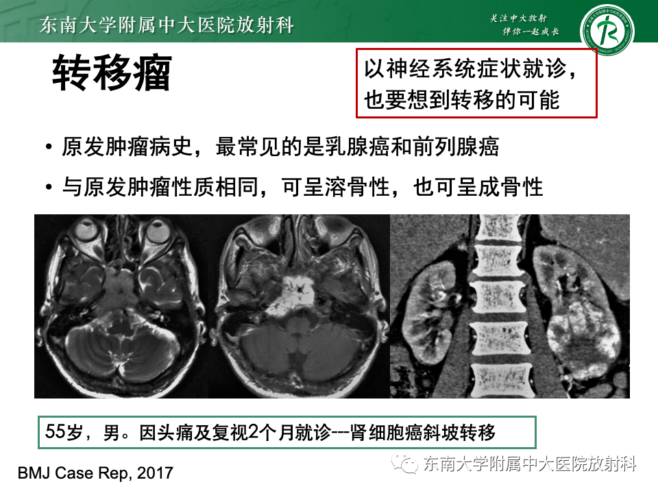 影像PPT - 【PPT】斜坡骨质破坏性病变影像诊断-48