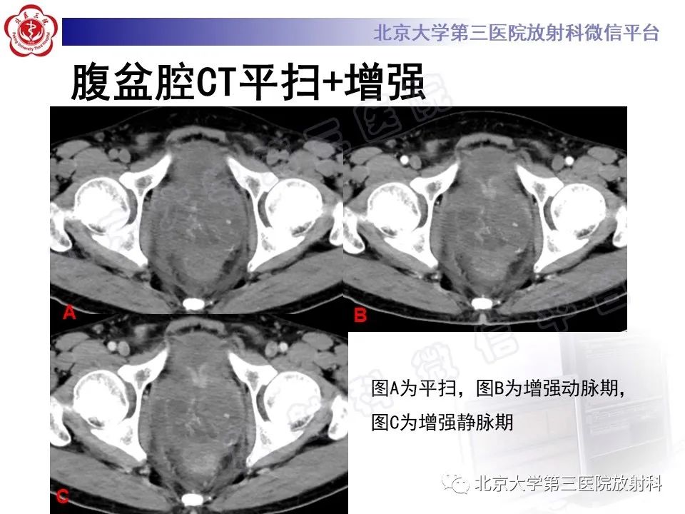 影像PPT - 【PPT】前列腺肉瘤-3
