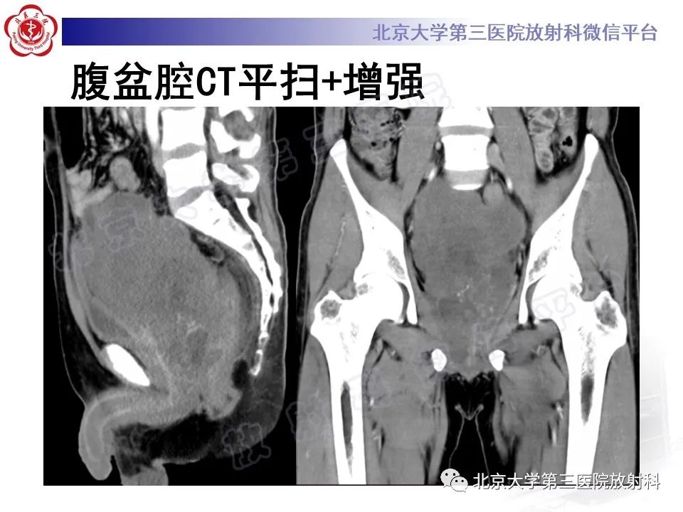 影像PPT - 【PPT】前列腺肉瘤-5