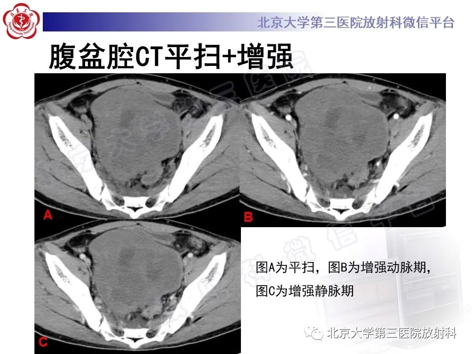 影像PPT - 【PPT】前列腺肉瘤-4