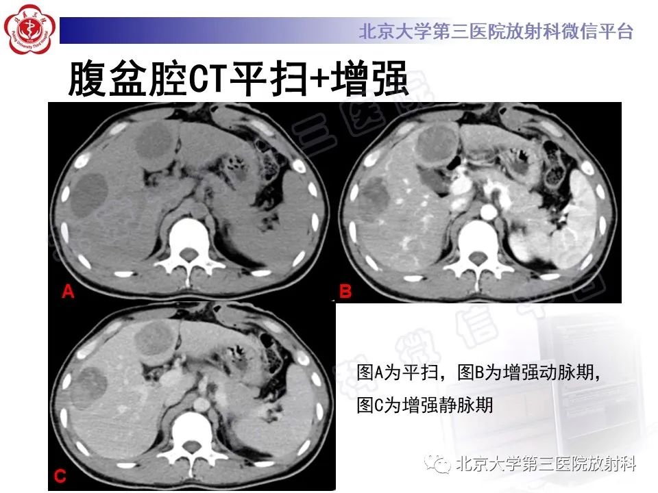 影像PPT - 【PPT】前列腺肉瘤-6