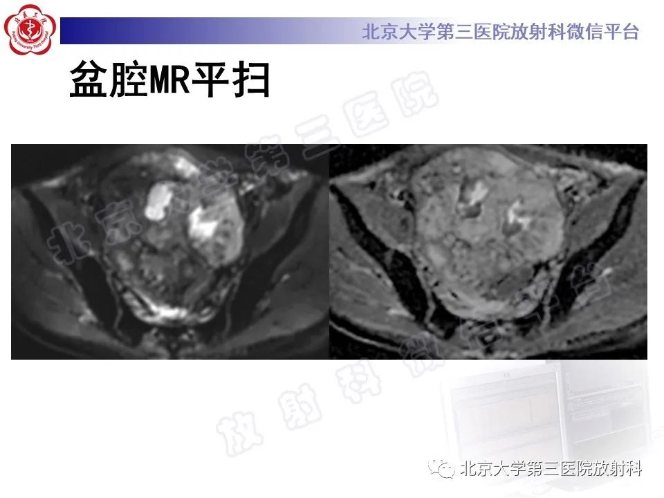 影像PPT - 【PPT】前列腺肉瘤-9