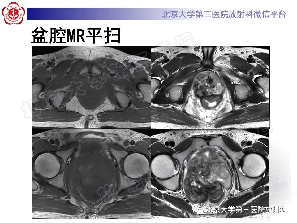 影像PPT - 【PPT】前列腺肉瘤-7