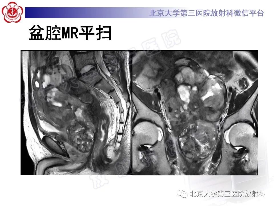 影像PPT - 【PPT】前列腺肉瘤-8