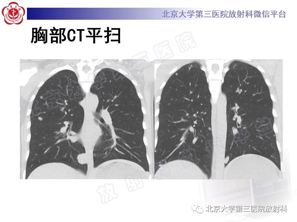 影像PPT - 【PPT】前列腺肉瘤-10