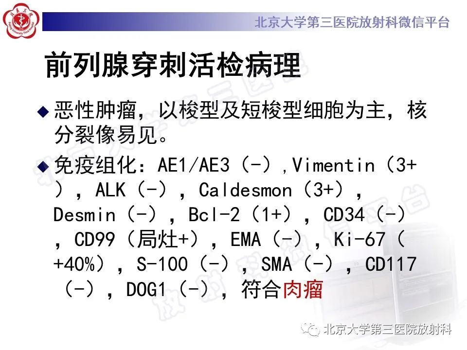 影像PPT - 【PPT】前列腺肉瘤-12