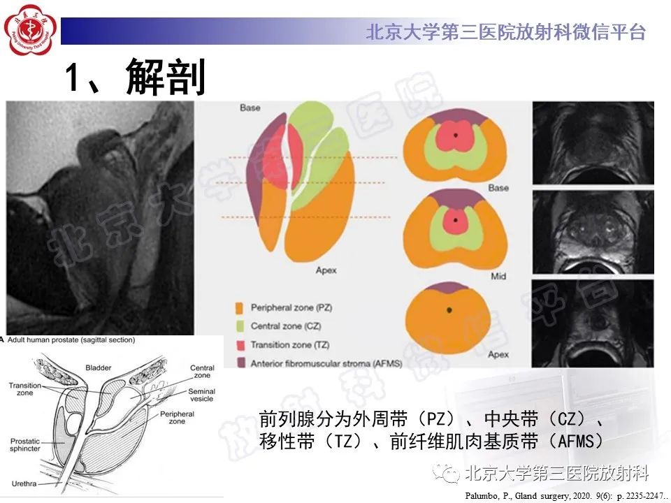影像PPT - 【PPT】前列腺肉瘤-14