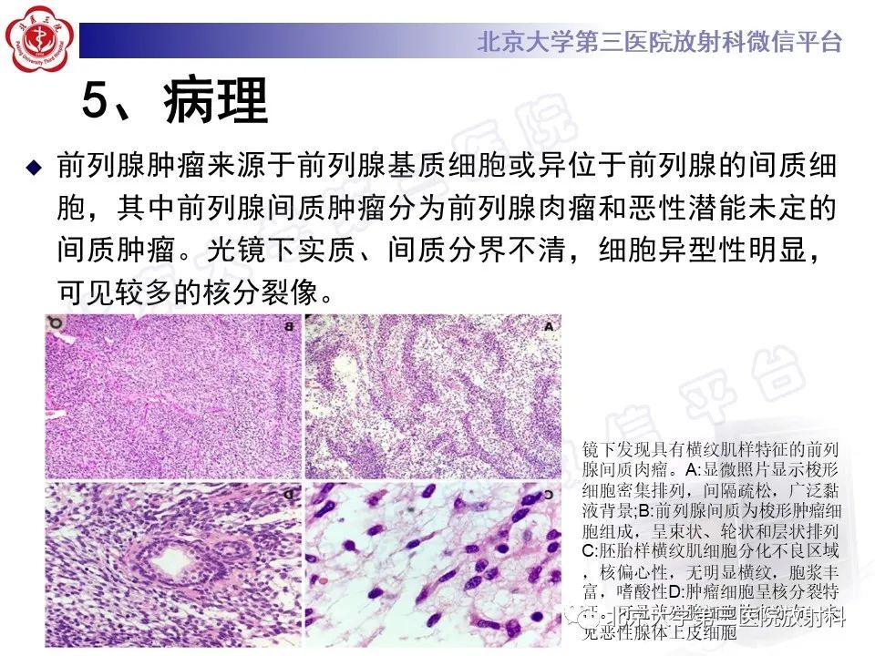 影像PPT - 【PPT】前列腺肉瘤-19