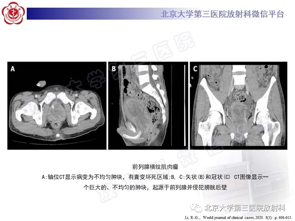 影像PPT - 【PPT】前列腺肉瘤-22