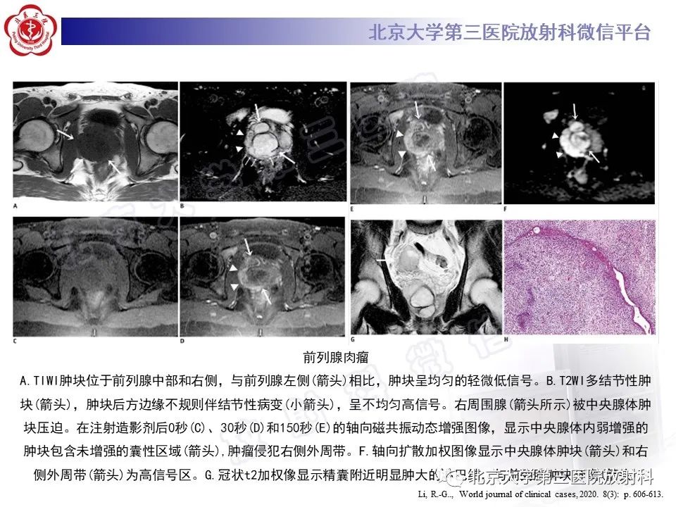 影像PPT - 【PPT】前列腺肉瘤-23