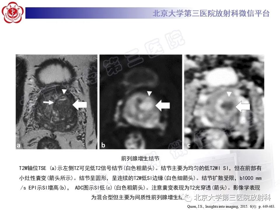 影像PPT - 【PPT】前列腺肉瘤-26