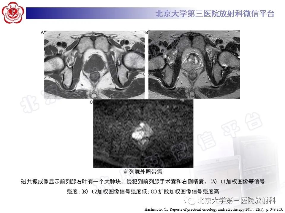 影像PPT - 【PPT】前列腺肉瘤-28