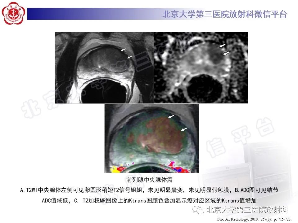 影像PPT - 【PPT】前列腺肉瘤-29