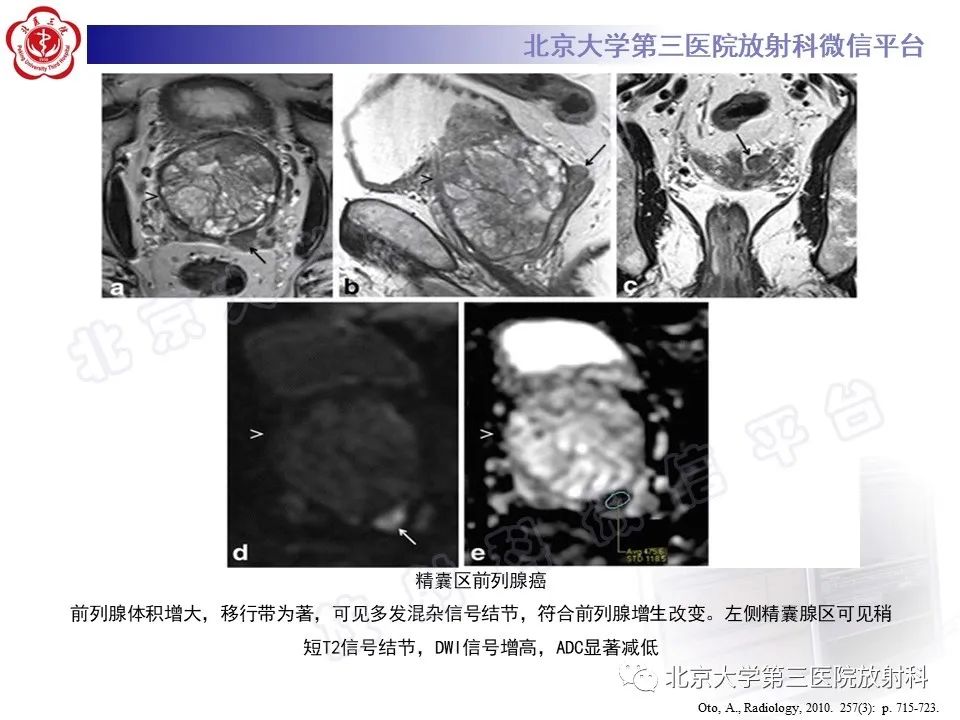 影像PPT - 【PPT】前列腺肉瘤-30