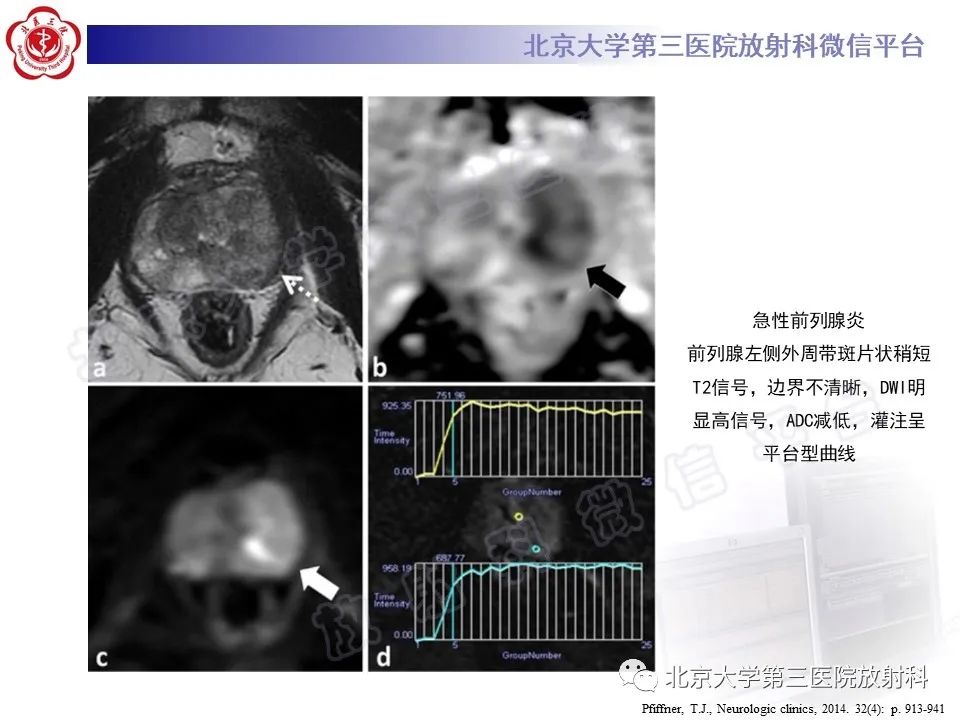 影像PPT - 【PPT】前列腺肉瘤-32