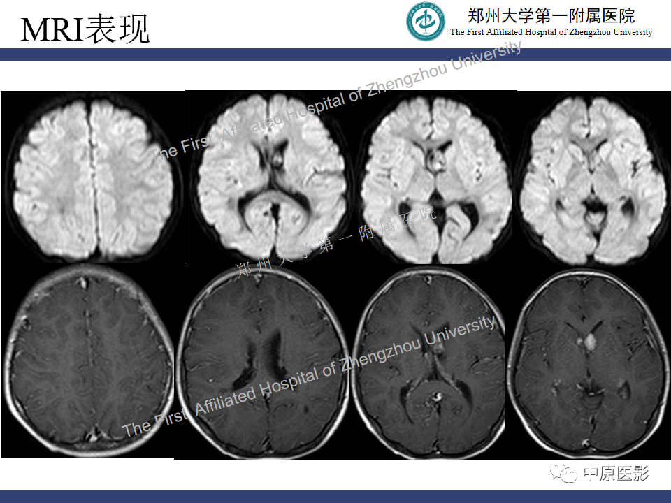 影像PPT - 【病例】室管膜下巨细胞星形细胞瘤1例MR影像-5