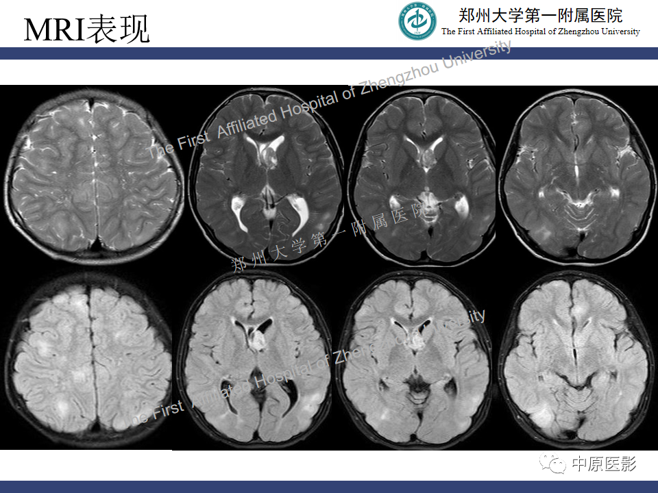 影像PPT - 【病例】室管膜下巨细胞星形细胞瘤1例MR影像-4