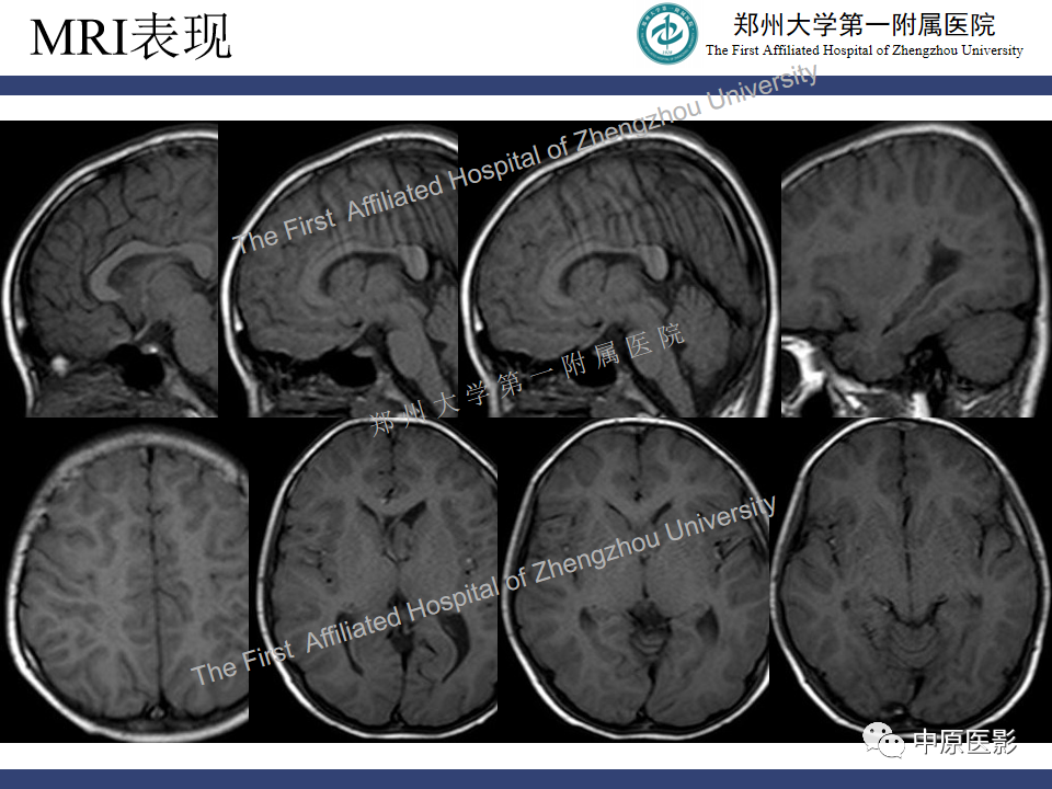 影像PPT - 【病例】室管膜下巨细胞星形细胞瘤1例MR影像-3