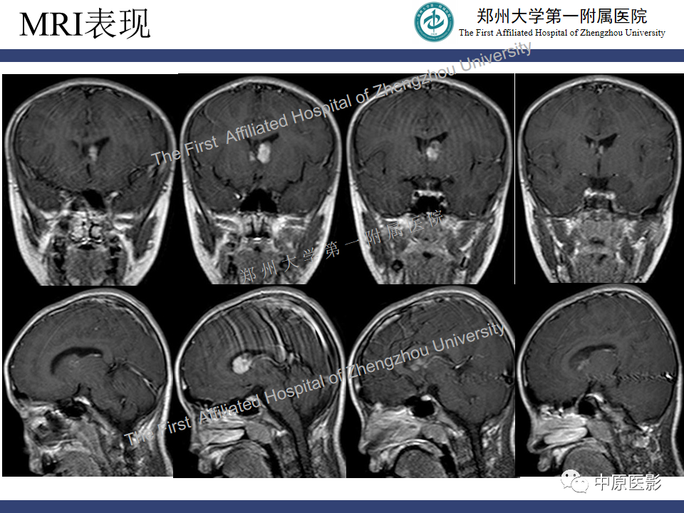 影像PPT - 【病例】室管膜下巨细胞星形细胞瘤1例MR影像-6