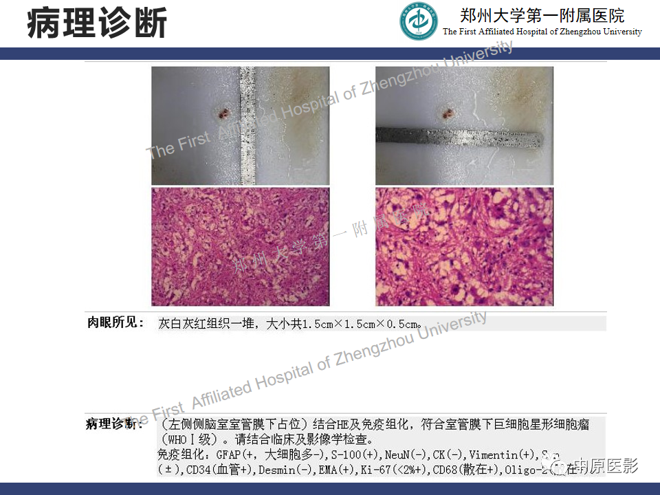 影像PPT - 【病例】室管膜下巨细胞星形细胞瘤1例MR影像-9