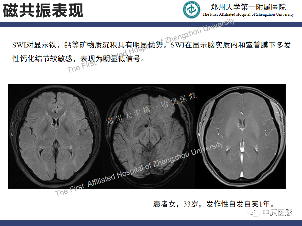 影像PPT - 【病例】室管膜下巨细胞星形细胞瘤1例MR影像-13