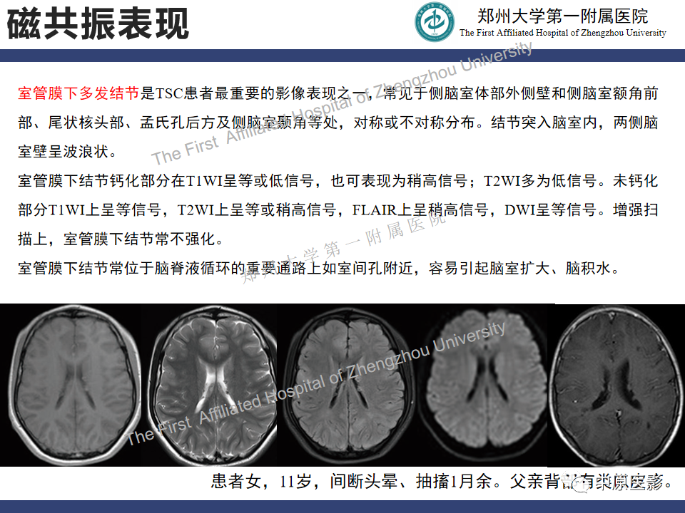 影像PPT - 【病例】室管膜下巨细胞星形细胞瘤1例MR影像-12