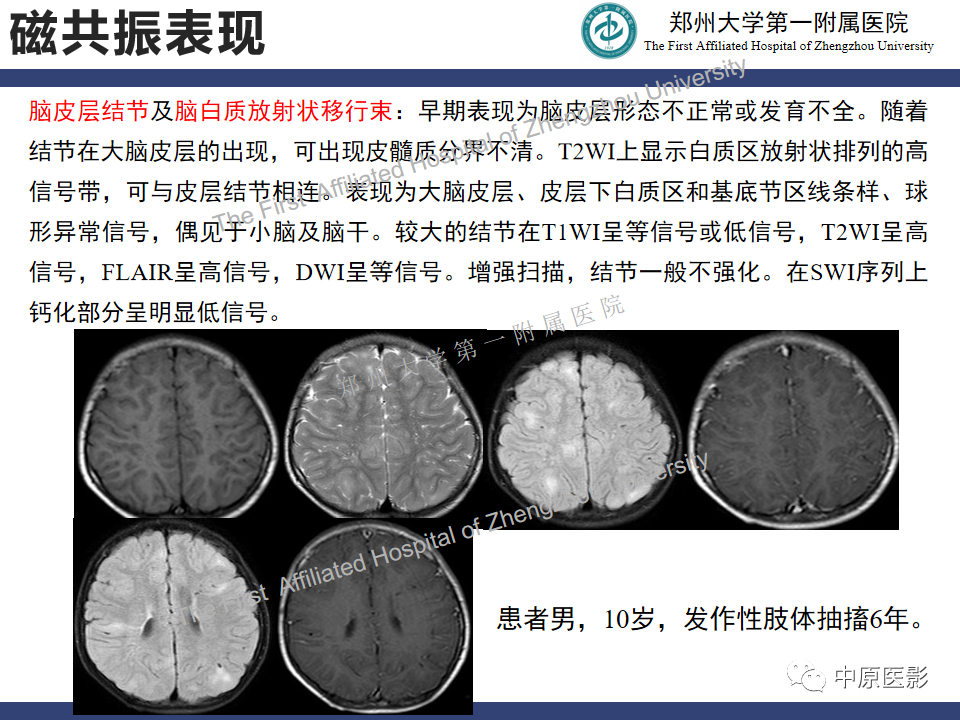 影像PPT - 【病例】室管膜下巨细胞星形细胞瘤1例MR影像-14