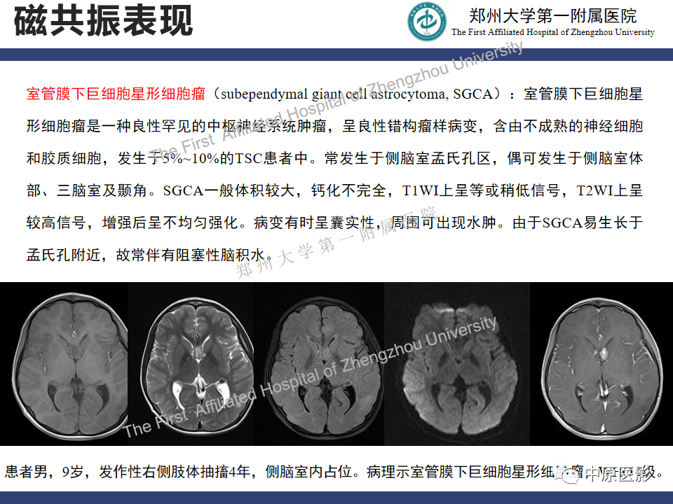影像PPT - 【病例】室管膜下巨细胞星形细胞瘤1例MR影像-15