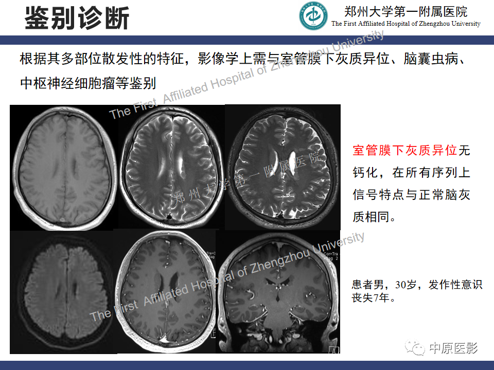 影像PPT - 【病例】室管膜下巨细胞星形细胞瘤1例MR影像-18
