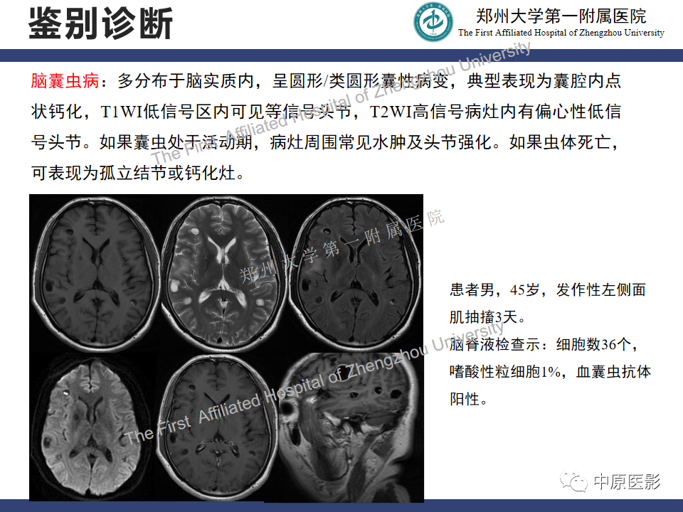 影像PPT - 【病例】室管膜下巨细胞星形细胞瘤1例MR影像-19