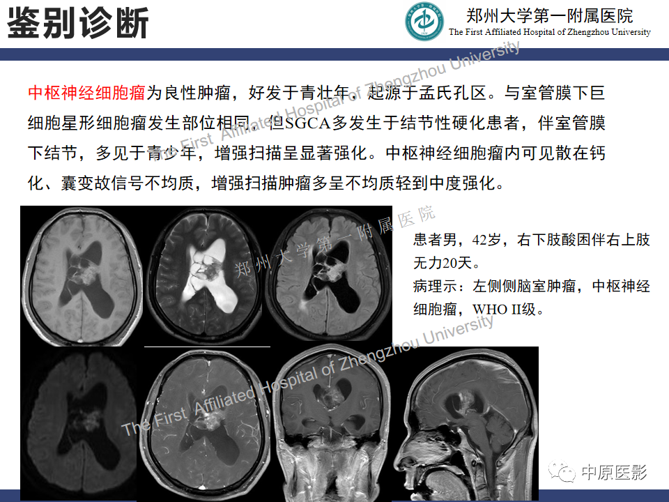 影像PPT - 【病例】室管膜下巨细胞星形细胞瘤1例MR影像-20