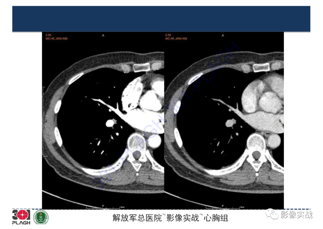 影像PPT - 【病例】肺炎性肌纤维母细胞瘤1例CT影像-4