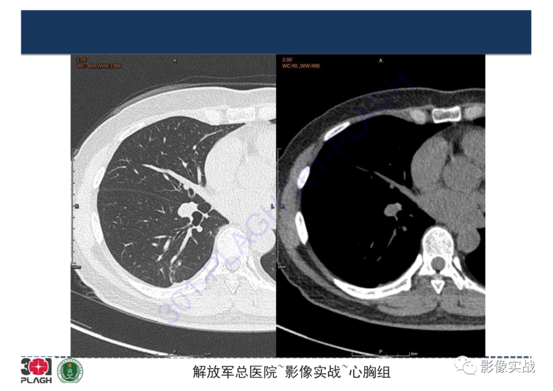 影像PPT - 【病例】肺炎性肌纤维母细胞瘤1例CT影像-3