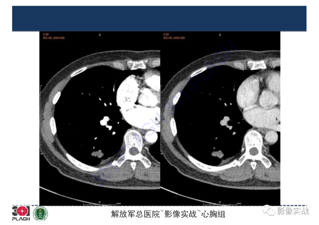 影像PPT - 【病例】肺炎性肌纤维母细胞瘤1例CT影像-10