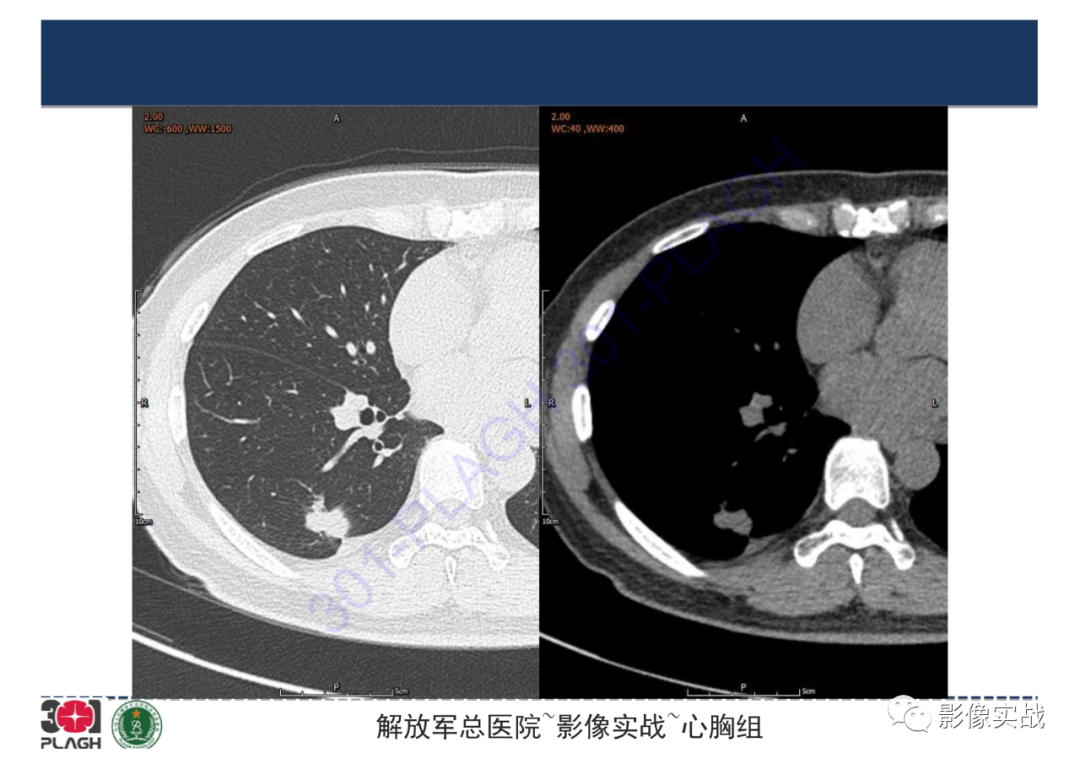 影像PPT - 【病例】肺炎性肌纤维母细胞瘤1例CT影像-11