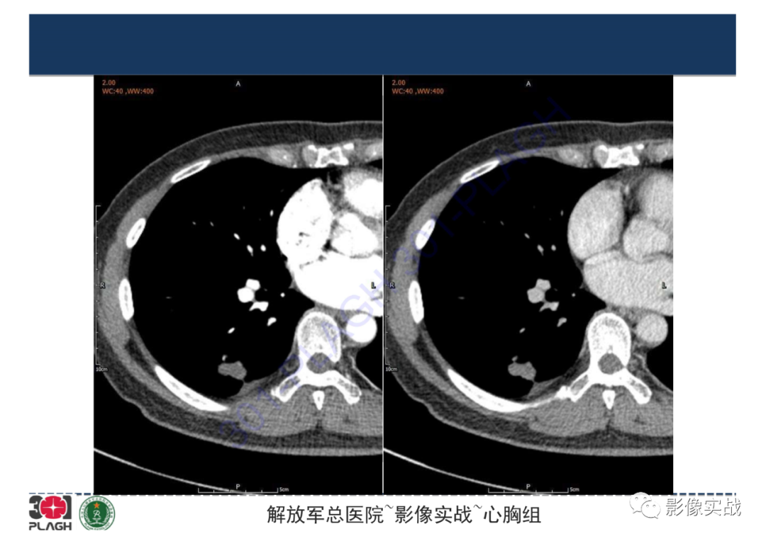 影像PPT - 【病例】肺炎性肌纤维母细胞瘤1例CT影像-12